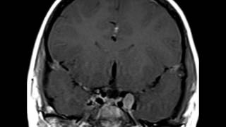 Neurofibromatosis Type 2 [upl. by Anaerdna53]