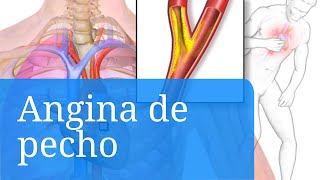 Angina de pecho síntomas tipos y cómo detectarla [upl. by Ateinotna]