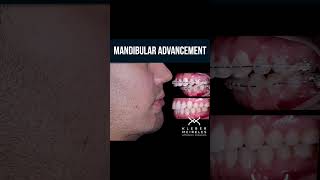 MANDIBULAR ADVANCEMENT  ORTHODONTIC TIPS Shorts [upl. by Varini984]