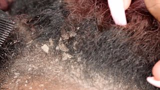 ITCHY DRY SCALP  SCRATCHING DANDRUFF  RAKING SCALP [upl. by Femmine]