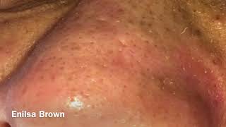 Blackheads Extractions and Acne Treatment on Daryl [upl. by Adahs]