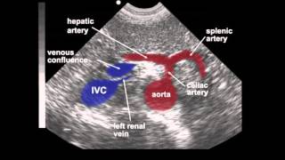 Abdominal Aortic Aneurysm AAA Ultrasound [upl. by Zelikow]