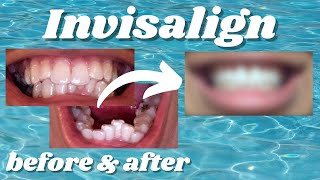 My Incredible Invisalign Transformation [upl. by Ainoda]