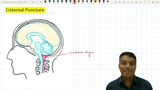 Cisternal Puncture  Suboccipital Puncture [upl. by Rashidi992]