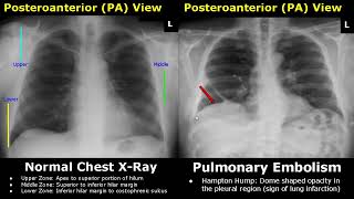 Chest XRay Lung Normal Vs Abnormal Image Appearances Part 2  Pleural EffusionPneumothorax PA CXR [upl. by Fezoj]