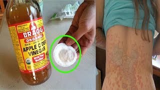 tinea versicolor treatment  how to get rid of tinea versicolor natural treatment [upl. by Reehsab845]