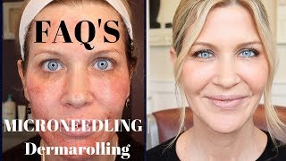 Microneedling  Dermarolling QampA  Before During and After Pics [upl. by Irep]