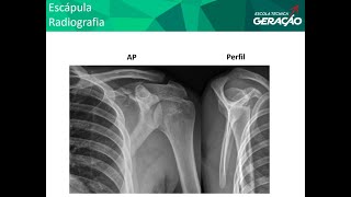 Radiografia de Escápula  AP  Perfil [upl. by Hesky]