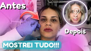 PREENCHIMENTO LABIAL E NAS OLHEIRAS COM ÁCIDO HIALURÔNICO Antes depois e Valores [upl. by Cassius]