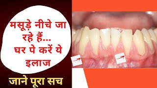 मसूड़े के नीचे जाने का इलाज  Gums Recession Causes Treatment [upl. by Aisorbma]