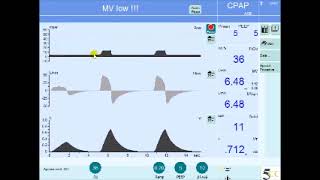 Pressure Support Ventilation PSV Description amp Settings [upl. by Amisoc]