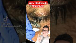 Crazy BLACKHEAD REMOVAL UNDER EYE  How Did This Happen shorts [upl. by Dlared655]