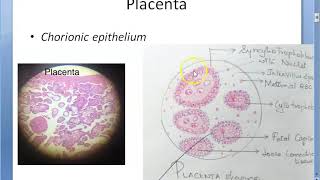 Malignant Gestational Trophoblastic Disease  CRASH Medical Review Series [upl. by Ydak941]