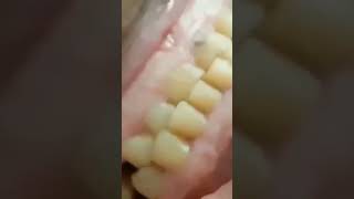 What does BRUXISM or Teeth Grinding sound like [upl. by O'Gowan284]