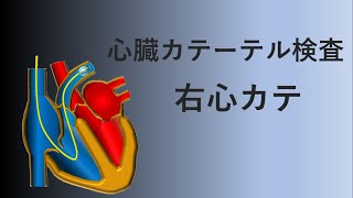 【心臓カテーテル検査】右心カテとは、どんな検査？何が分かるの？ [upl. by Llenral]