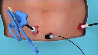 3d Sigmoid colon surgery [upl. by Ynohtona]