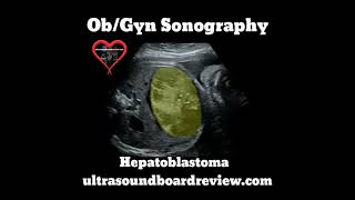 Hepatoblastoma Ultrasound [upl. by Ewell]