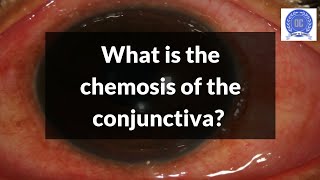 What is Conjunctival Chemosis [upl. by Ecneret]