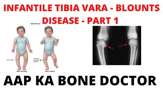 INFANTILE TIBIA VARA OR BLOUNTS DISEASE  PART 1  EPISODE 32 [upl. by Dwyer]