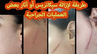 إزالة آثار الجروح و النذوب و الحبوب،إزالة سيكاطريس الولادة القيصرية [upl. by Anaiv]