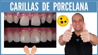 CARILLAS de PORCELANA 😮 ANTES y DESPUÉS ⭐ ¡No te Pierdas este CASO que te MUESTRO [upl. by Einhpets]