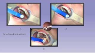 RPE Expander Instruction  Smile Solutions Orthodontists [upl. by Kial]