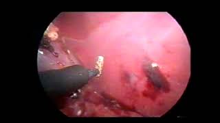 Laparoscopic splenectomy [upl. by Neau33]