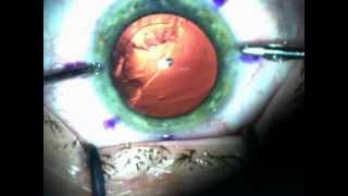 Clear lens extraction with Alcon Acrysof IQ Restor Toric DrMishevavi [upl. by Ahsienod21]