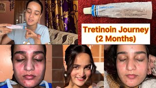 2 Month RetinolTretinoin Journey✨ [upl. by Jude]