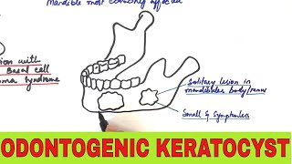 Odontogenic Keratocyst  Clinical Radiographic and Histopathologic Features [upl. by Faux427]