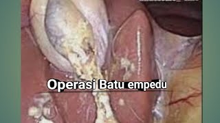 Laparoskopi batu empedu Proses pengangkatan Batu Empedu [upl. by Sarine]