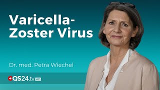 Windpocken amp Gürtelrose Gemeinsamkeiten und Schutzmassnahmen  Dr med Petra Wiechel  QS24 [upl. by Enrica]