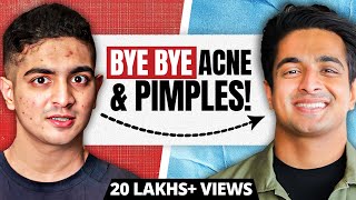 Top 3 Apple Cider Vinegar Benefits  Remove Pimples Acne amp Dandruff  Ranveer Allahbadia [upl. by Droc879]