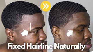 How I FIXED My Hairline Naturally  Receding Hairline [upl. by Retsevel512]