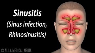 Sinusitis Animation [upl. by Khalin]