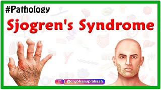 Sjogrens syndrome Usmle  Etiology  Clinical features  Diagnosis  Treatment [upl. by Hahcim]