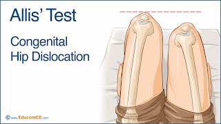 Allis Test [upl. by Kimon]