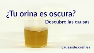 Causas de orina oscura [upl. by Iralav]