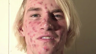 ZIT FACE GUY  PIMPLE ACNE EXPLOSION [upl. by Hayse]