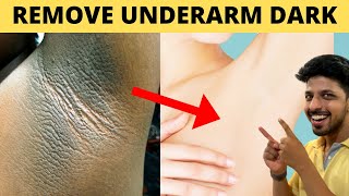 Get Rid of Dark Armpits in 10 Mins at Home [upl. by Atnuhs]