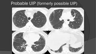 HRCT Imaging of Fibrotic Interstitial Lung Disease New Classification of UIP [upl. by Seagrave]