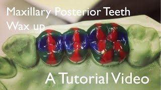 Maxillary posterior teeth  Wax up [upl. by Gerek101]