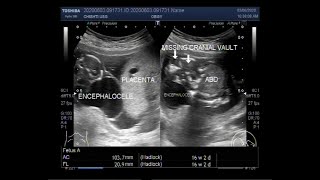 Anencephaly and Encephalocele with a pregnancy of about 16 weeks [upl. by Hselin304]