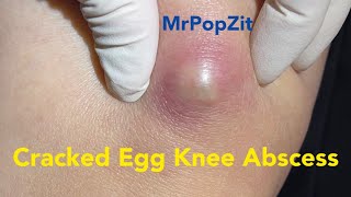 Cracked Egg Knee Abscess Large mass on knee under pressure and painful Pressure relieved [upl. by Akcirret]