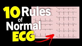 Intro to EKG Interpretation  Myocardial Infarctions Part 2 of 2 [upl. by Llertnom]