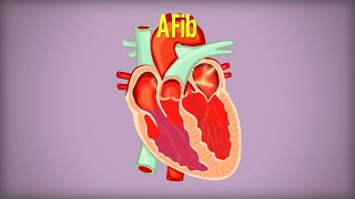 Living with Atrial Fibrillation AFib [upl. by Halvaard895]