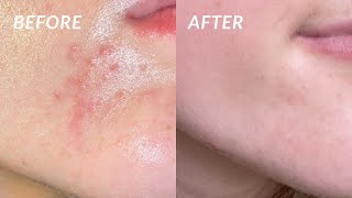 How I COMPLETELY got rid of my PERIORAL DERMATITIS in 4 DAYS the secret cure [upl. by Imac]