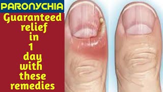 Paronychia finger home remedies  Paronychia fungal nail infection  Paronychia nail home remedies [upl. by Naujaj]