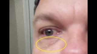 Getting Rid Face Skin Blemishes Naturally WATER FASTING Day 18 Xanthelasma yellow bumps under eyes [upl. by Mimajneb]