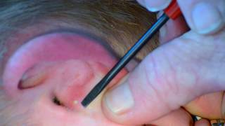 Painful Ear Pimple Popped and Slowly Pressured [upl. by Anhej578]